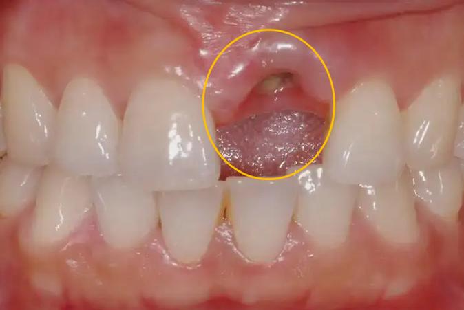 种牙后牙槽骨萎缩为何发生？原因与应对方法-图2