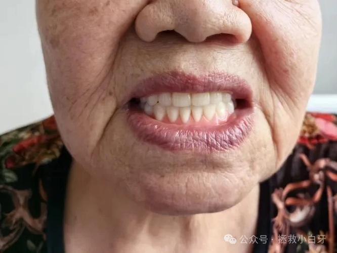 种牙后牙槽骨萎缩为何发生?原因与应对方法-图3 种牙后牙槽骨萎缩为何发生?原因与应对方法-图3