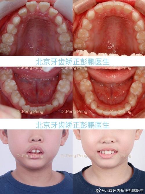 门牙多生牙正畸病例集,多生牙如何影响正畸效果?-图2 门牙多生牙正畸病例集,多生牙如何影响正畸效果?-图2