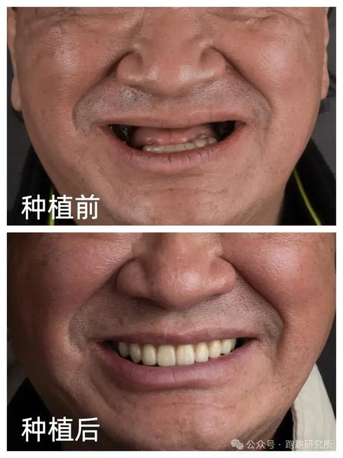 全口牙种牙哪里做好?靠谱医院和医生怎么选?-图1 全口牙种牙哪里做好?靠谱医院和医生怎么选?-图1