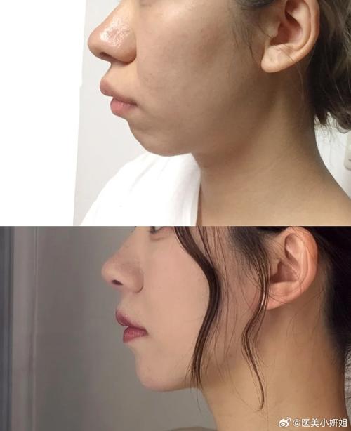 正颌手术前正畸很难看-图3