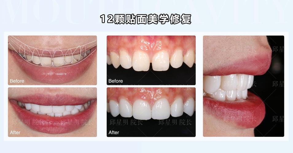 美加牙贴面拆除方法有哪些？哪种更安全？-图1