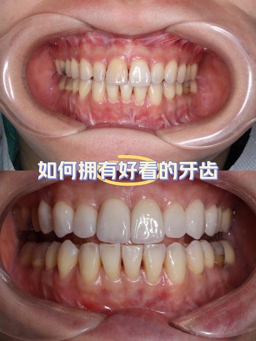 美加牙贴面拆除方法有哪些？哪种更安全？-图3