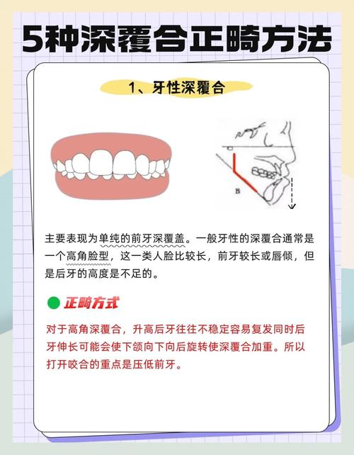 磨牙深覆盖正畸方法有哪些？不同矫正方式效果差异多大？-图1