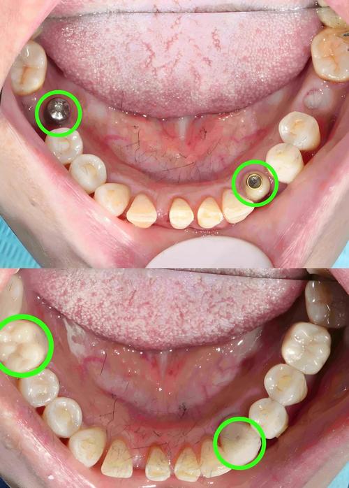 种牙是否需要原来的牙？-图2