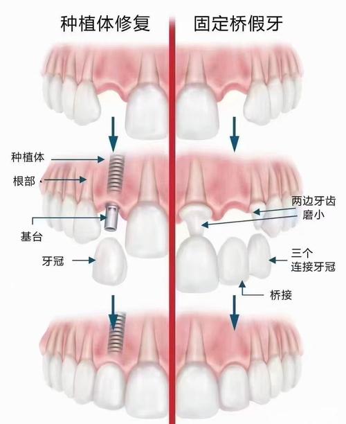 缺一颗牙镶牙还是种牙？哪种方式更适合？如何科学选择？-图2