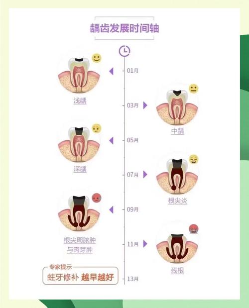 龋齿治疗方法有哪些？图片能直观展示哪些治疗步骤？-图2