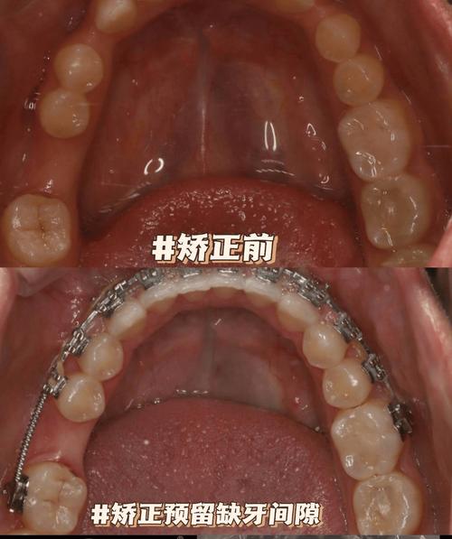 临牙倾斜种牙为何要先矫正？-图1