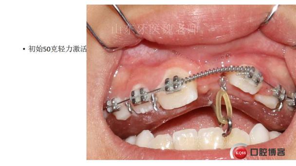 埋伏牙牵引后正畸护理有哪些关键要点需注意？-图3