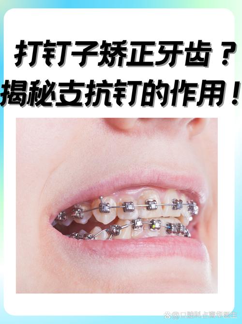 如何有效增加前牙支抗？实用方法有哪些？-图3
