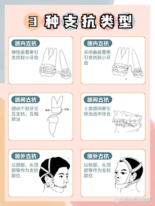 如何有效增加前牙支抗？实用方法有哪些？-图2