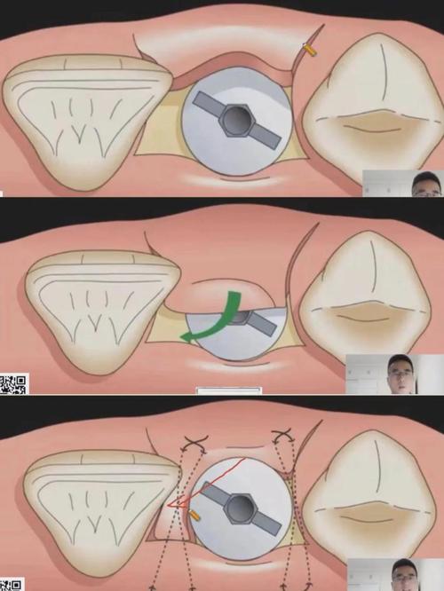 牙龈切口缝合方法有哪些关键步骤?-图1 牙龈切口缝合方法有哪些关键步骤?-图1