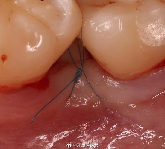 牙龈切口缝合方法有哪些关键步骤?-图2 牙龈切口缝合方法有哪些关键步骤?-图2