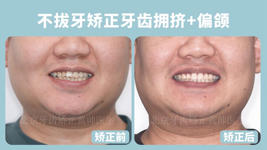 正畸前牙往后收5mm,效果如何实现?-图1 正畸前牙往后收5mm,效果如何实现?-图1