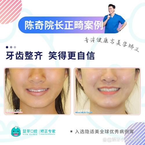 矫正牙齿突出的方法有哪些?-图3 矫正牙齿突出的方法有哪些?-图3