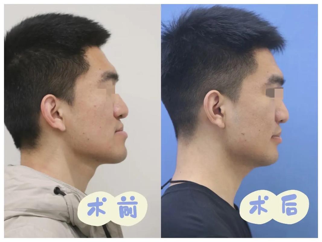 正畸为何倾向国外，正颌倾向国内？选择差异的原因是什么？-图3