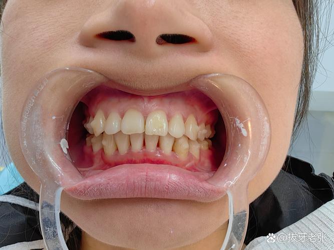 龋齿很严重可以正畸么-图3