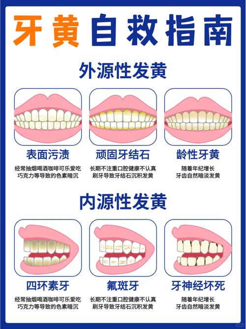 黄斑牙的最佳治疗方法是什么？如何选择安全有效的治疗方式？-图1