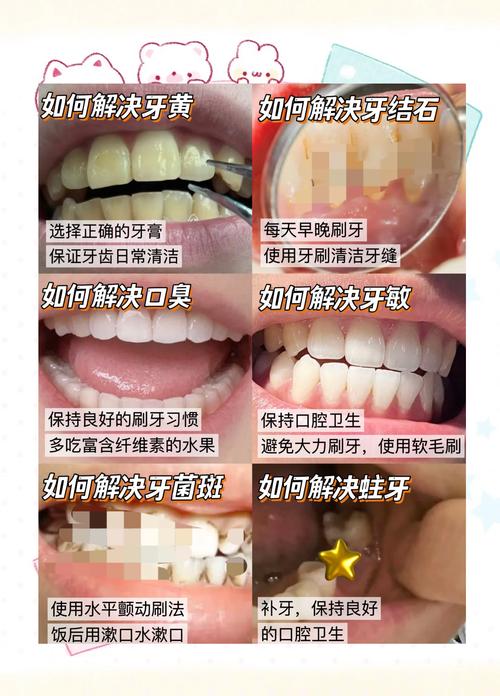 黄斑牙的最佳治疗方法是什么？如何选择安全有效的治疗方式？-图2