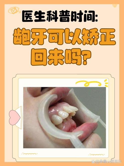 矫正龅牙有哪些方法？不同矫正方式该如何选择？-图3