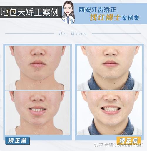 西安交大校医院正畸怎么样？学生效果和体验如何？-图2