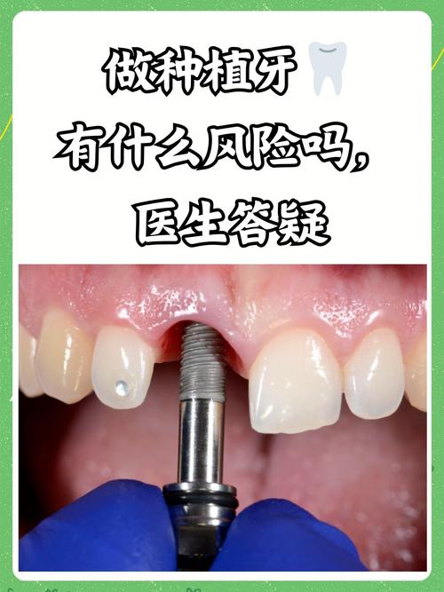 种牙内提是什么?揭秘种植牙内提技术与优势-图3 种牙内提是什么?揭秘种植牙内提技术与优势-图3