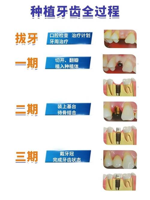 种牙内提是什么？揭秘种植牙内提技术与优势-图2
