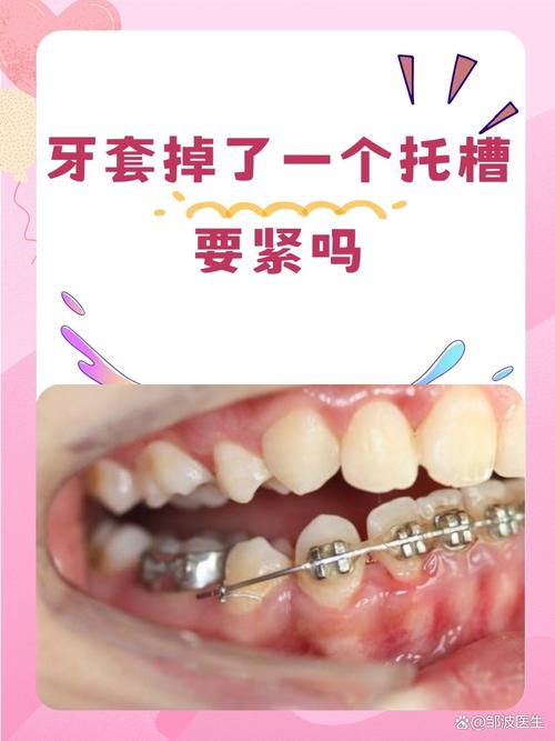 正畸佩戴牙托槽会引起头痛吗?这种不适感是正常现象吗?-图1 正畸佩戴牙托槽会引起头痛吗?这种不适感是正常现象吗?-图1