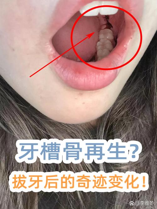 拔牙后长时间不种牙,对邻牙、牙槽骨及咬合功能有何影响?-图1 拔牙后长时间不种牙,对邻牙、牙槽骨及咬合功能有何影响?-图1