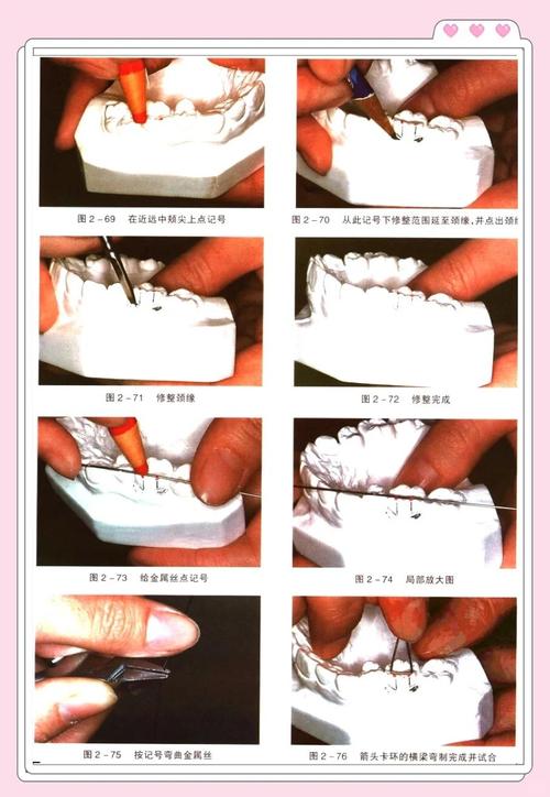 虎牙矫正美容冠方法如何选择与应用?-图2 虎牙矫正美容冠方法如何选择与应用?-图2