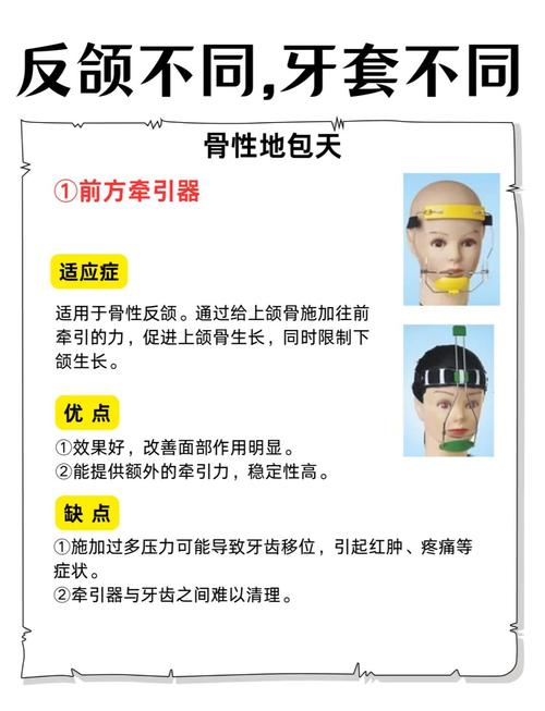 儿童地包天矫正方法有哪些？如何选对适合的治疗方式？-图2