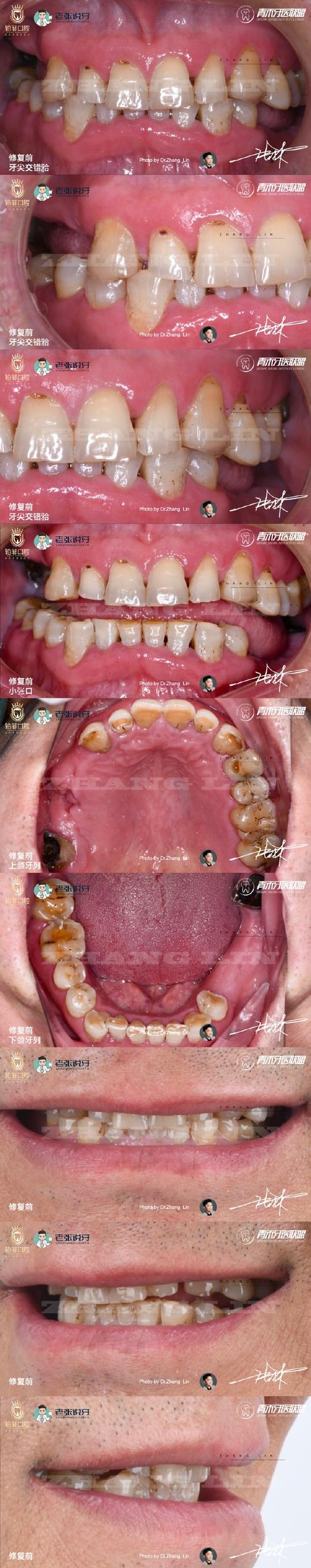 口腔咬合重建的方法有哪些？不同方法的适用情况及效果如何选择？-图1