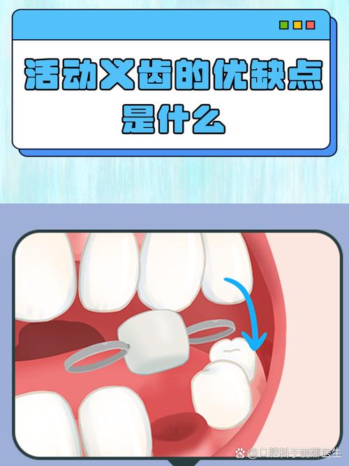 活动义齿设计方法的关键步骤与原则有哪些?-图1 活动义齿设计方法的关键步骤与原则有哪些?-图1