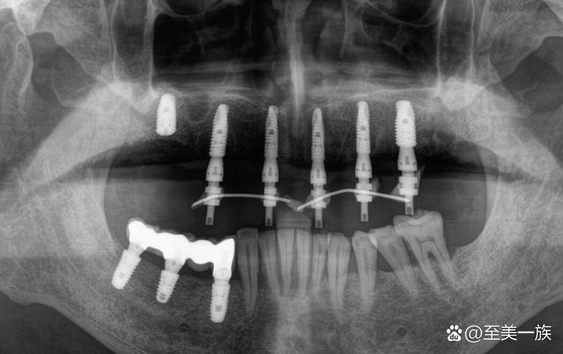 种牙可以核磁共振吗-图2 种牙可以核磁共振吗-图2
