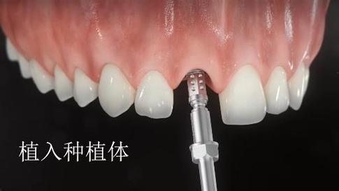 即拔即种牙拔牙后能立刻种植吗?整个治疗周期需要多长时间才能完成?-图3 即拔即种牙拔牙后能立刻种植吗?整个治疗周期需要多长时间才能完成?-图3