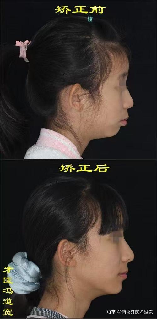 南京牙齿正畸怎么选靠谱医院？医生资质、价格差异、矫正效果这些坑要注意吗？-图2