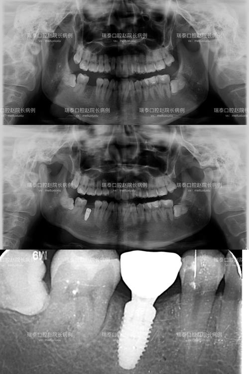 种牙会影响CT检查结果准确性吗?CT成像又是否会对种牙方案制定产生干扰?-图2 种牙会影响CT检查结果准确性吗?CT成像又是否会对种牙方案制定产生干扰?-图2