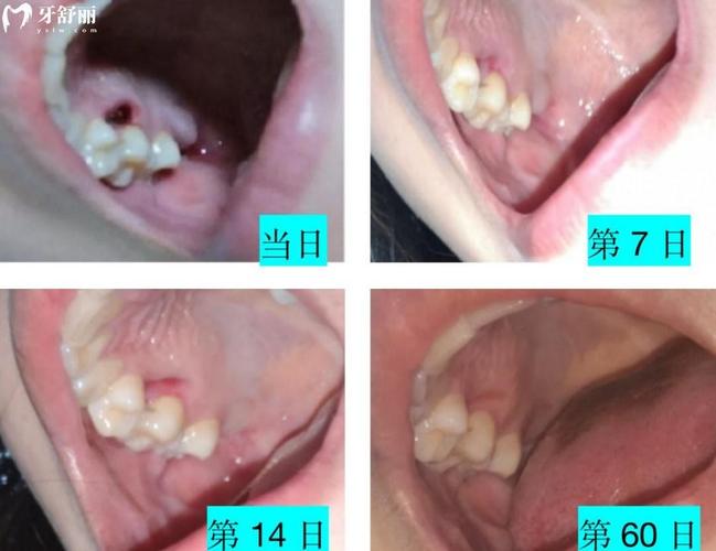 种牙后伤口愈合需要多久?不同阶段恢复时间有何差异?护理要点会影响愈合进程吗?-图1 种牙后伤口愈合需要多久?不同阶段恢复时间有何差异?护理要点会影响愈合进程吗?-图1