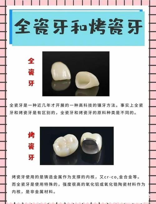 镶牙、种牙、烤瓷牙三者有何本质区别?适用人群与优缺点分别是什么?-图1 镶牙、种牙、烤瓷牙三者有何本质区别?适用人群与优缺点分别是什么?-图1