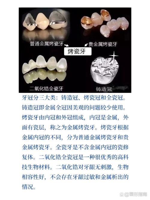镶牙、种牙、烤瓷牙三者有何本质区别?适用人群与优缺点分别是什么?-图2 镶牙、种牙、烤瓷牙三者有何本质区别?适用人群与优缺点分别是什么?-图2