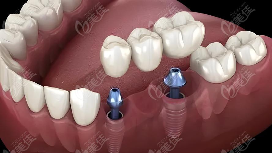 种牙材质怎么选?纯钛、锆、合金各有优劣,到底哪种更适合你的口腔状况和长期使用需求?-图1 种牙材质怎么选?纯钛、锆、合金各有优劣,到底哪种更适合你的口腔状况和长期使用需求?-图1