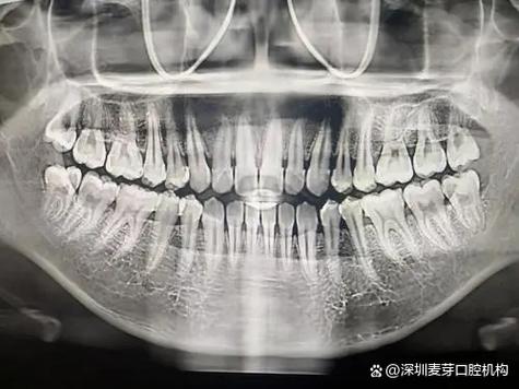 牙周炎影像检查方法有哪些?不同影像学检查手段(如X线片、CBCT等)在诊断中各有何优势和适用场景?-图2 牙周炎影像检查方法有哪些?不同影像学检查手段(如X线片、CBCT等)在诊断中各有何优势和适用场景?-图2