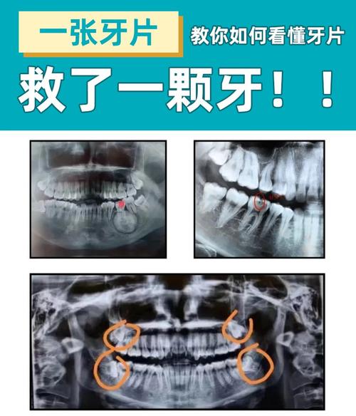 牙周炎影像检查方法有哪些?不同影像学检查手段(如X线片、CBCT等)在诊断中各有何优势和适用场景?-图1 牙周炎影像检查方法有哪些?不同影像学检查手段(如X线片、CBCT等)在诊断中各有何优势和适用场景?-图1