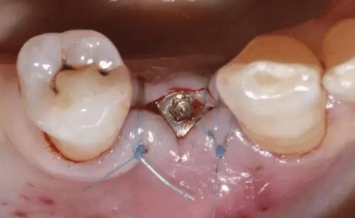 种牙拆线后能喝酒吗？饮酒会影响伤口愈合吗？有哪些注意事项需要了解？-图2