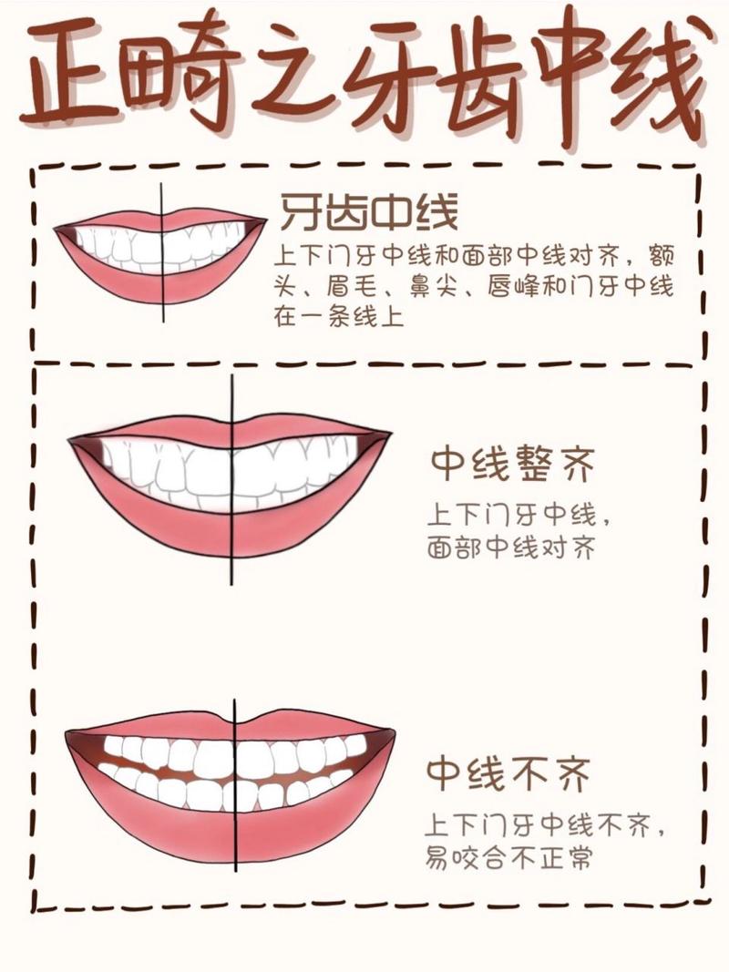 牙齿正畸中线调整是关键步骤吗?具体在矫正流程中属于第几阶段?-图1 牙齿正畸中线调整是关键步骤吗?具体在矫正流程中属于第几阶段?-图1