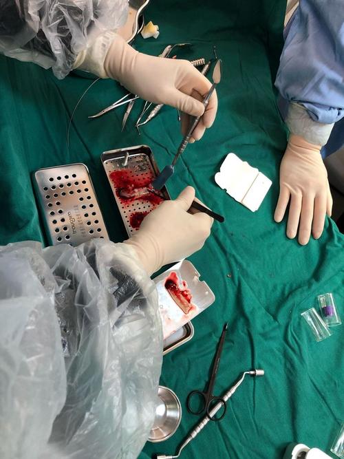 CGF临床应用方法的具体操作流程及不同适应症下的制备参数如何规范？-图1