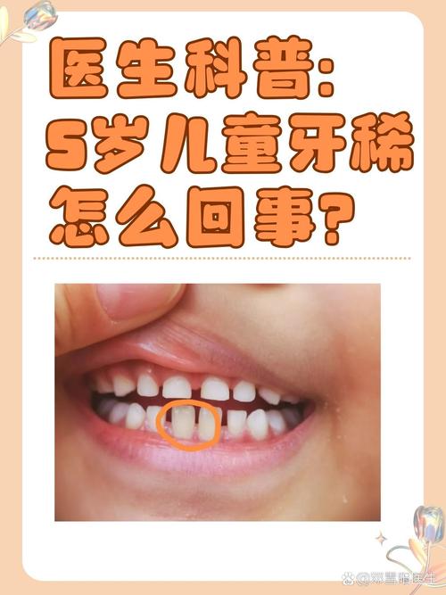 牙齿稀疏有哪些治疗方法？不同矫正方式适合哪些人群？治疗后需要注意哪些事项？-图2