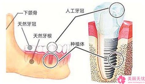 韩国种牙技术靠谱吗？材料安全有保障吗？性价比高不高？适合哪些人群做？值得选择吗？-图2