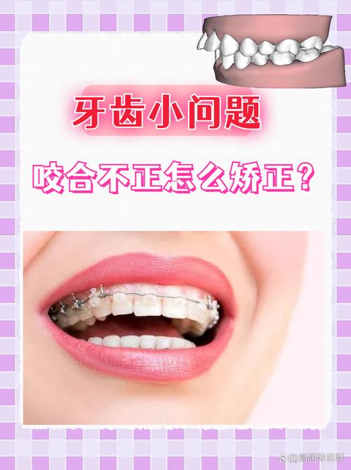 咬合不齐有哪些常见治疗方法?不同矫正方式适合哪些人群?效果如何及需要注意什么?-图3 咬合不齐有哪些常见治疗方法?不同矫正方式适合哪些人群?效果如何及需要注意什么?-图3