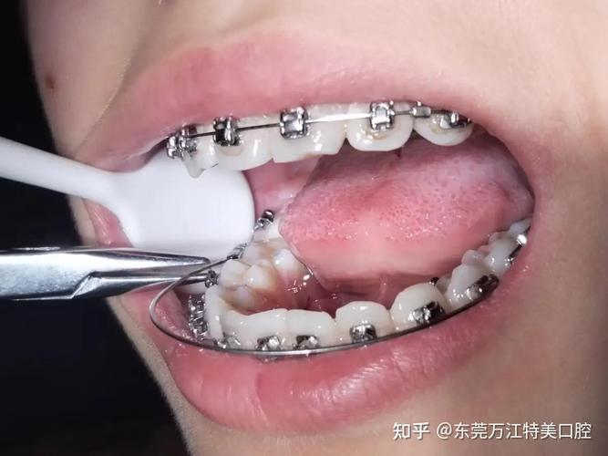 在东莞哪里正畸牙齿好-图2